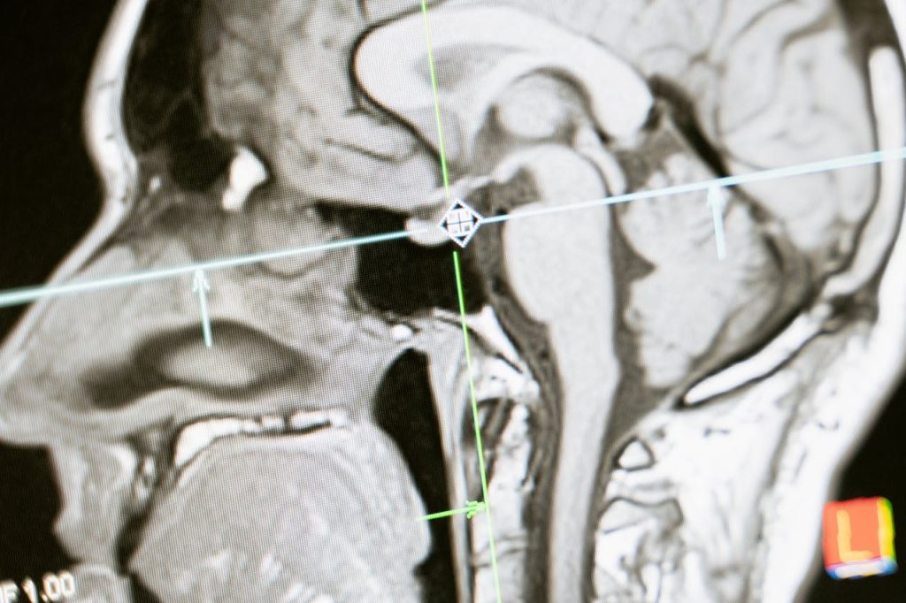MRI scan of a human head in profile view, showing detailed cross-sectional structures of the brain, nasal cavity, and skull with intersecting reference lines.