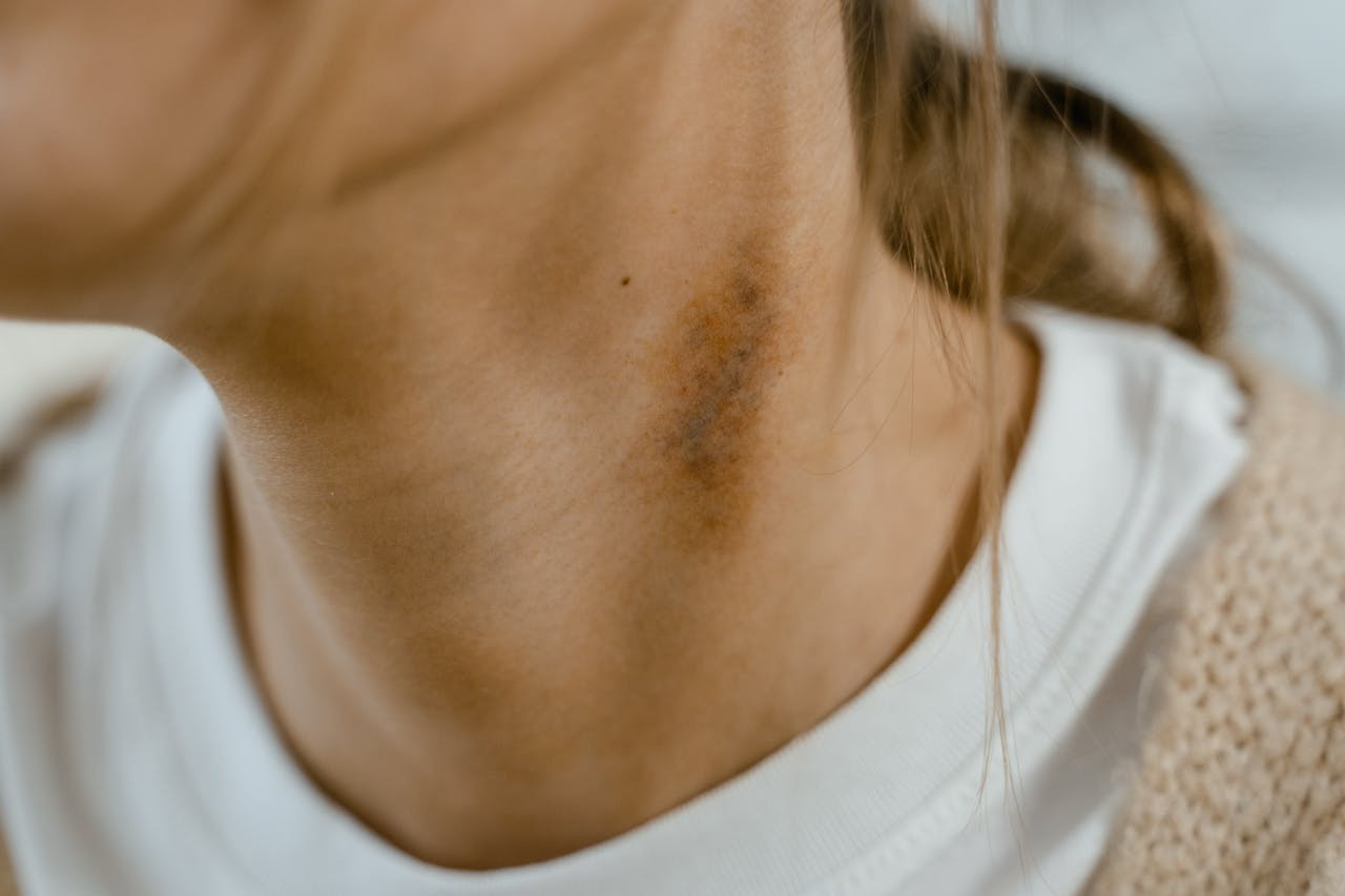 Close-up of a person's neck showing a dark bruise or mark on the skin, with part of a white shirt and beige sweater visible.